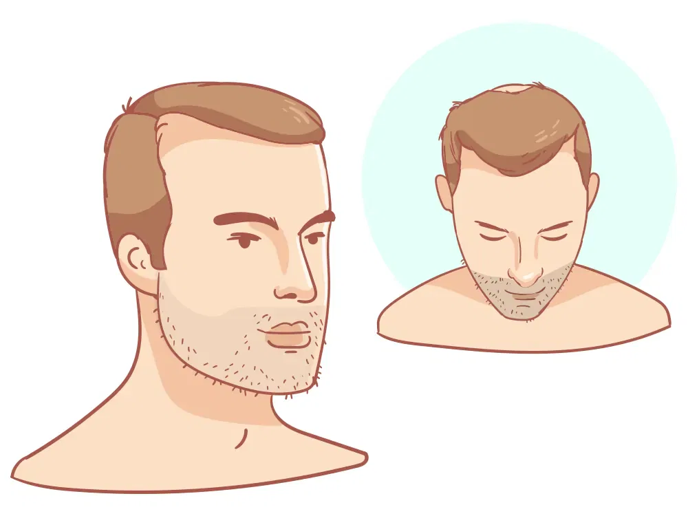 Ligne de cheveux en recul + couronne légère