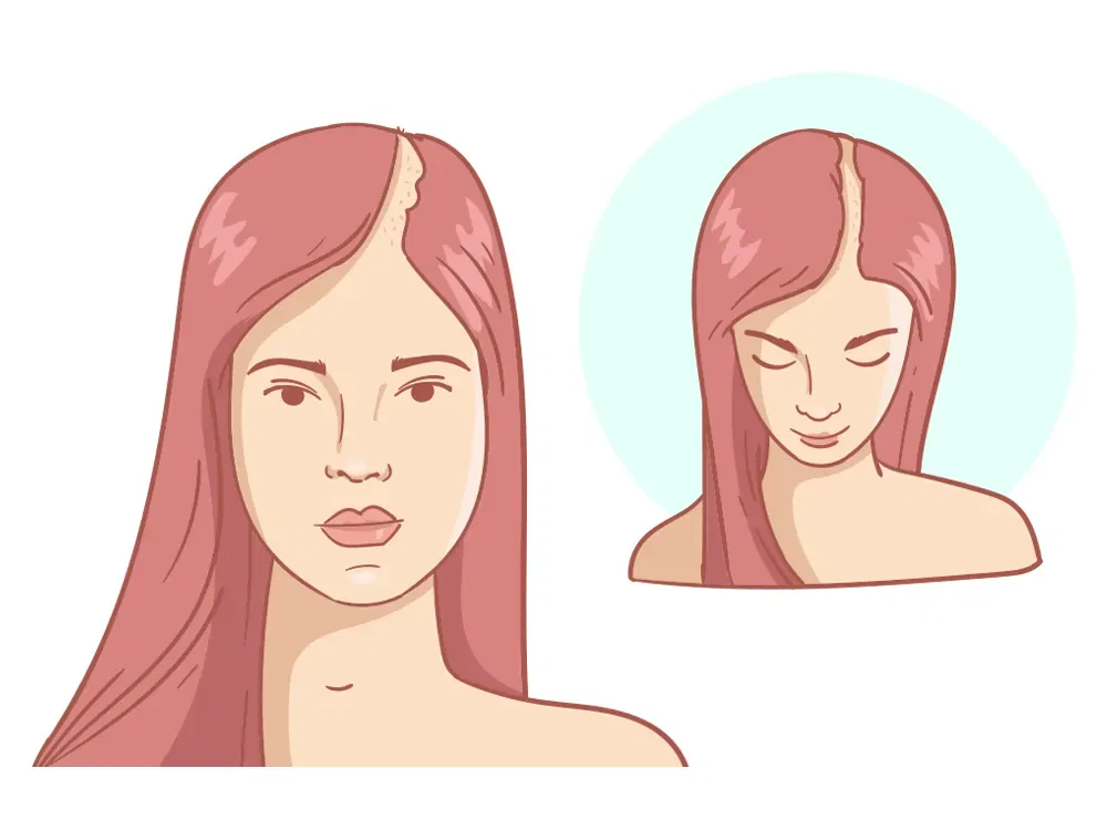 Ligne de cheveux en recul Strong + Crown